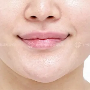 リップアート＆えくぼ形成 BEFORE