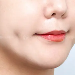 えくぼ形成 AFTER