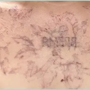 タトゥー除去 AFTER