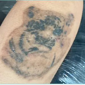 タトゥー除去 BEFORE