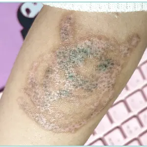 タトゥー除去 AFTER