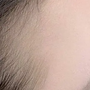 ヘアライン BEFORE