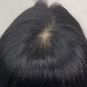 ヘアラインアートメイク BEFORE