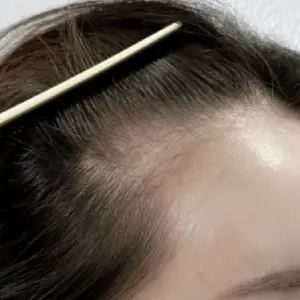 ヘアラインアートメイク BEFORE