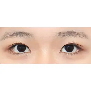 非切開二重まぶた（自然癒着） AFTER