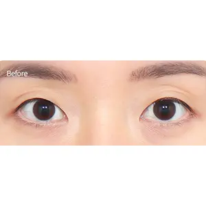 非切開二重まぶた（自然癒着） BEFORE