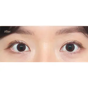 非切開二重まぶた（自然癒着） AFTER