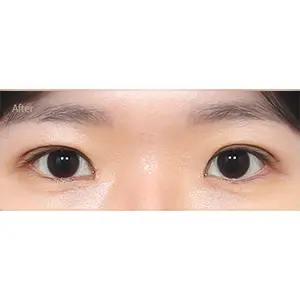 切開+トリム成形 AFTER