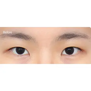 自然癒着+フロントトイム BEFORE