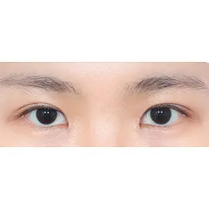 自然癒着+フロントトイム AFTER