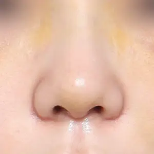 鼻再手術 - 鼻の補形物の傾き矯正 AFTER