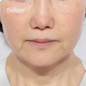 リフティング再手術 BEFORE