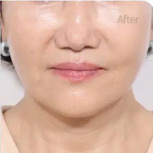 リフティング再手術 AFTER