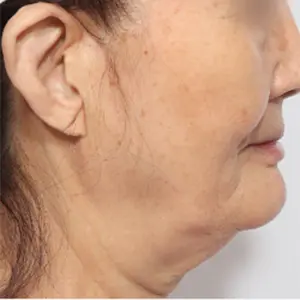 フェイスリフティング BEFORE