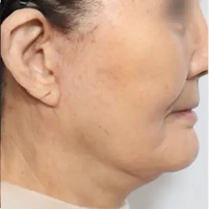 フェイスリフティング AFTER