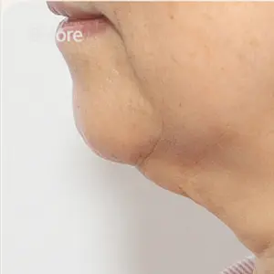 二重あご吸引 BEFORE