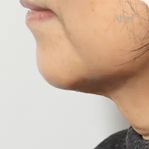 二重あご吸引 AFTER