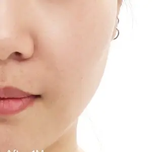 AIスキンブースター AFTER