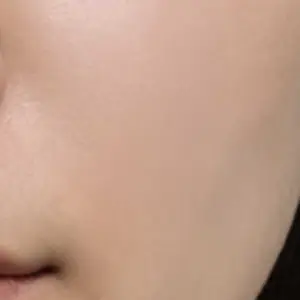 ボトックス AFTER