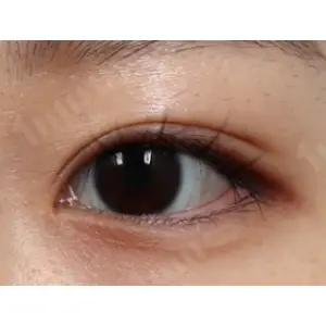 二重切開+目頭・目尻・たれ目 AFTER