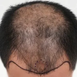 頭頂部+M字5500毛 BEFORE