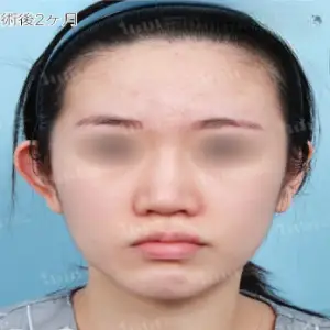 顔の脂肪移植 AFTER