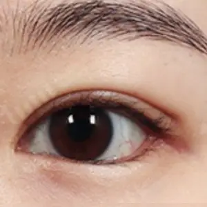 目尻切開+たれ目形成 AFTER