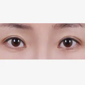 自然癒着法 AFTER