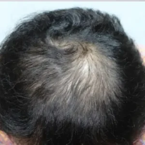 頭頂部4000毛 BEFORE