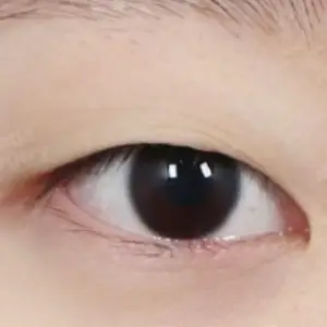 自然癒着法 BEFORE