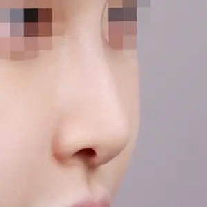 鼻筋+鼻先 BEFORE