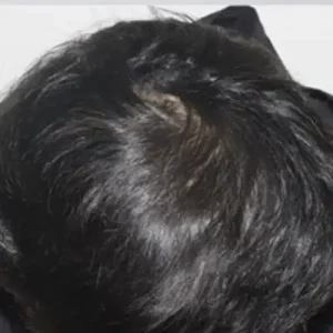 頭頂部4000毛 AFTER