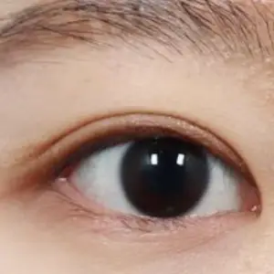 自然癒着法 AFTER