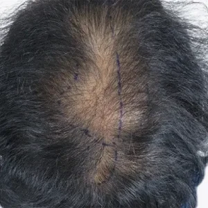 頭頂部4500毛 BEFORE