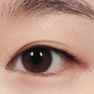 目尻切開+たれ目形成 BEFORE