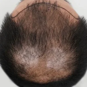 前頭部5500毛 BEFORE