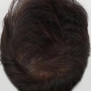 前頭部5500毛 AFTER