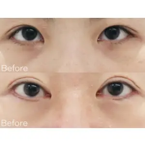 AIフィラー（目） BEFORE