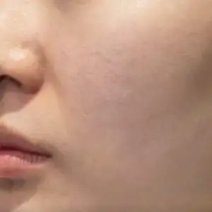 リジュラン BEFORE