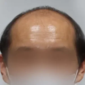 頭頂部+M字5500毛 BEFORE