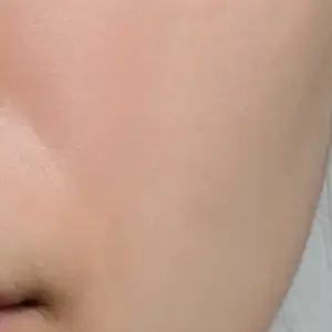 ボトックス BEFORE