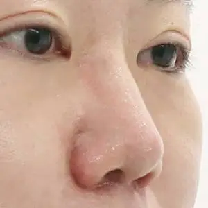 鼻フィラー+ミント糸4本 BEFORE