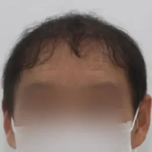 頭頂部+M字5500毛 AFTER