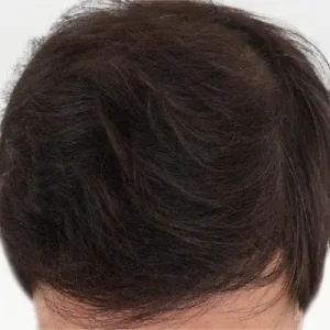 頭頂部+M字5500毛 AFTER