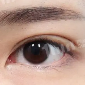 二重切開+目頭皮膚再配置 BEFORE