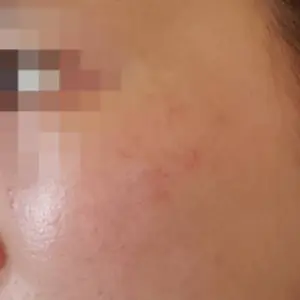 スキンブースター BEFORE