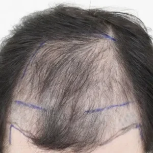 前頭部6000毛 BEFORE