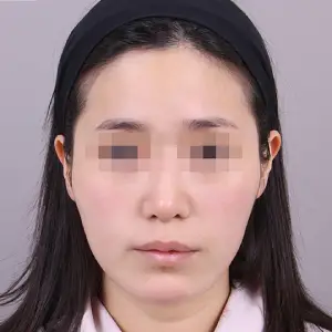 頬骨縮小+エラ削り+顎削り BEFORE