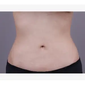 脂肪吸引（腹部） AFTER