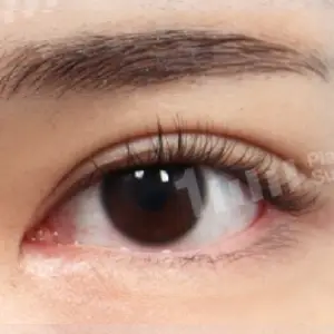 二重切開+目頭皮膚再配置 AFTER